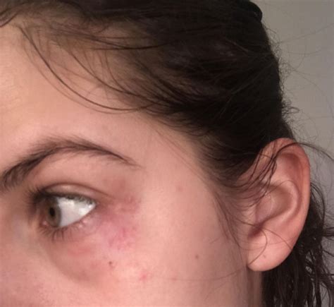 [skin Concern] What Are These Red Bumps Around My Eyes How Do I Get Rid Of Them Bumps Under