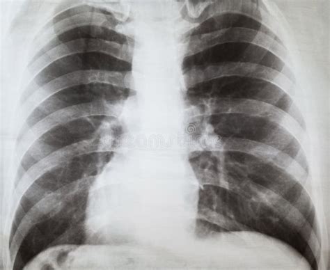 X-ray of human lungs stock image. Image of radiological - 285328247