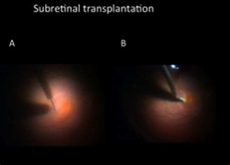 Subretinal Technique In This Technique A Cannula Is Connected To A
