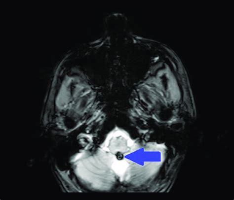 An Axial Gradient Echo Sequence Magnetic Resonance Imaging Brain Scan