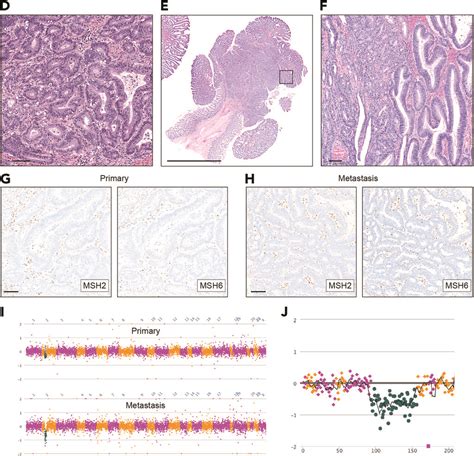 A Case Of Microsatellite Instabilityhigh Colon Cancer In A Young Woman