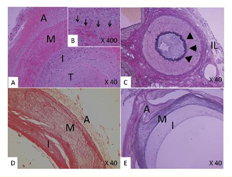 Figure 1 from Endarteritis obliterans in the pathogenesis of Buerger's disease from the ...