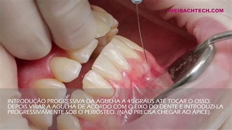 Morpheus Tasa Para Dentes Anteriores Inferiores T Cnicas