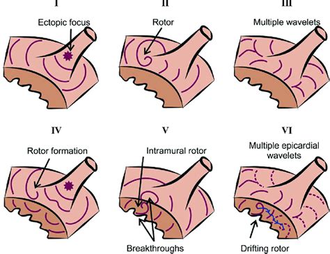 Mechanisms Of Af Maintenance Ectopic Foci On Pvs Rotors And