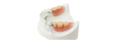 Partial Dentures Calgary Beddington Denture Centre