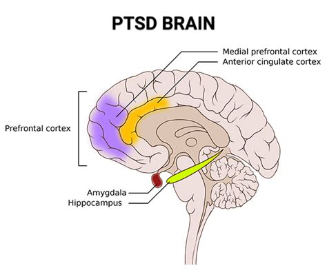 Ptsd Examined The Five Types Of Post Traumatic Stress Disorder Online Psychiatrists