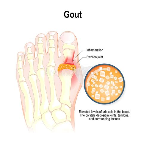 Gout of the big toe stock vector. Illustration of gouty - 26835333