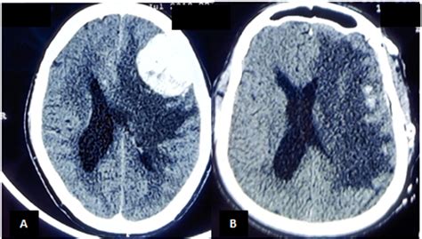 A Clinico Pathological And Neuro Radiological Study Of Angiomatous