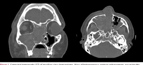 Figure From A Rare Case Of Giant Cavernous Hemangioma Of The