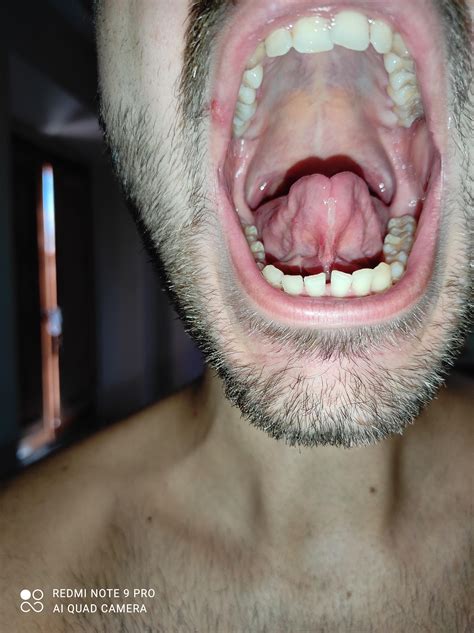 6 best r/tongueties images on Pholder | Pre and 13 days post frenectomy