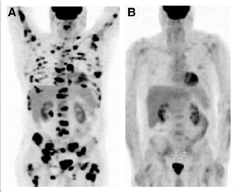 Posterior Iliac Crest Bone Marrow Biopsy