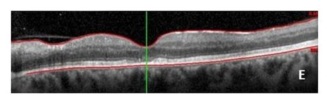 Early Intermediate And Late Phases Of Fluorescein Angiography A Download Scientific