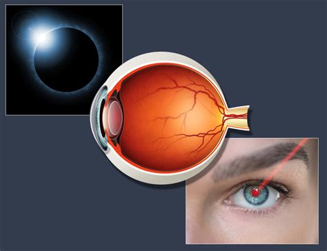 The Medical Minute Solar Eclipses And Laser Pointers Pose Similar Eye