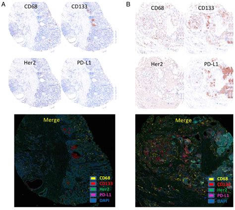 Prognostic Value Of PDL1 Expression And CD68 Macrophages In Tumor Nest