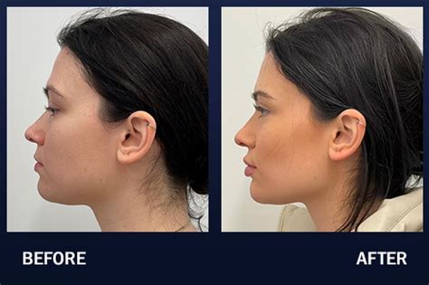 Chiseled Jaw Before And After