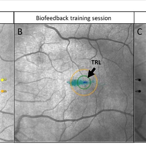 Principle Of Biofeedback Training BT A Pre BT Microperimetry