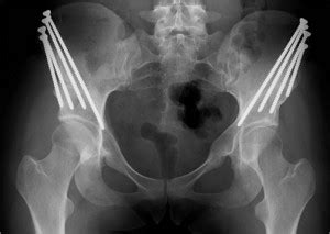 Periacetabular Osteotomy (PAO) for Acetabular Dysplasia St. Louis, MO ...