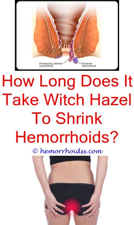 Pin On How To Get Rid Of External Hemorrhoids