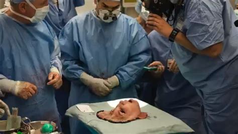 Face Transplant: How Surgeons Graft A Dead Donor's Face On a Living Recipient In This ...