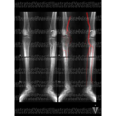 Stock Lower Limb Clots Plaques In Vasculature Illustrated Verdict