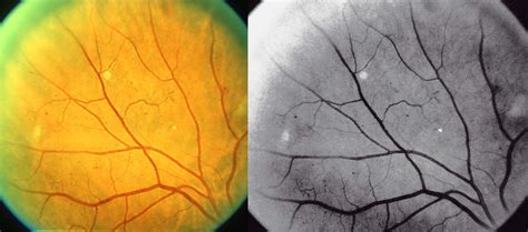 Diabetic Retinopathy Grading And Classification