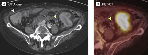 Diagnostic Accuracy Of Colorectal Cancer Staging With Whole Body PET CT