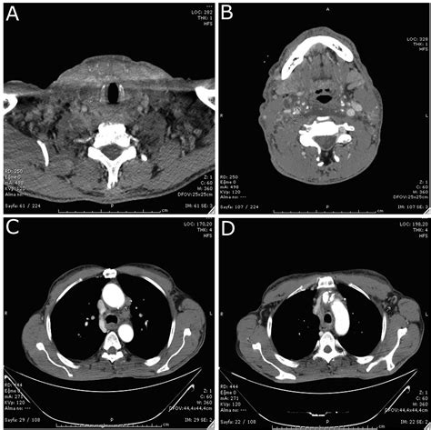 Anaplastic Thyroid Carcinoma With Diffuse Thoracic Skin Metastasis A