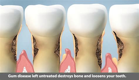 Gum Disease Bone Loss Pasadena Texas Dentist Dr Nugent