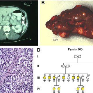 Type Papillary Kidney Cancer Hereditary Leiomyomatosis Renal Cell