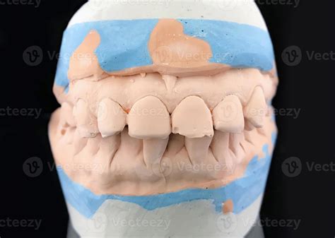 Plaster Casting Model On Black Background Close Up Dental Plaster