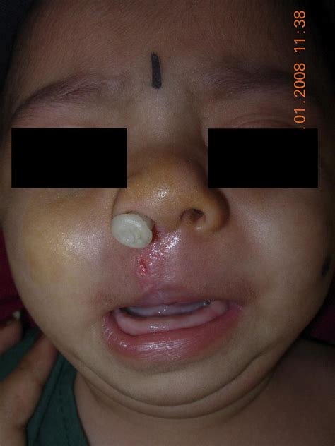 The Use Of A Simplified Nasal Stent In Infants With Complete Unilateral Cleft Lip And Palate