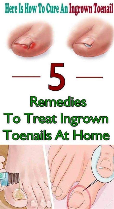 5 Remedies To Treat Ingrown Toenails At Home Health Recipes