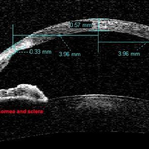 Illustration for defining the sclera spur and measuring parameters of ...