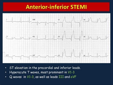 Myocardial Ischemia On Ecg