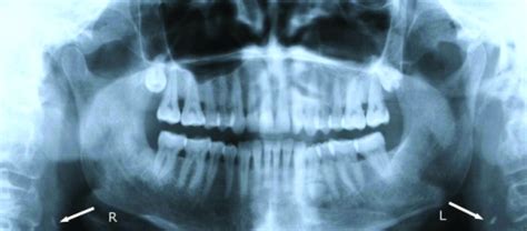 Carotid Artery: Carotid Artery Blockage On Panoramic X-ray