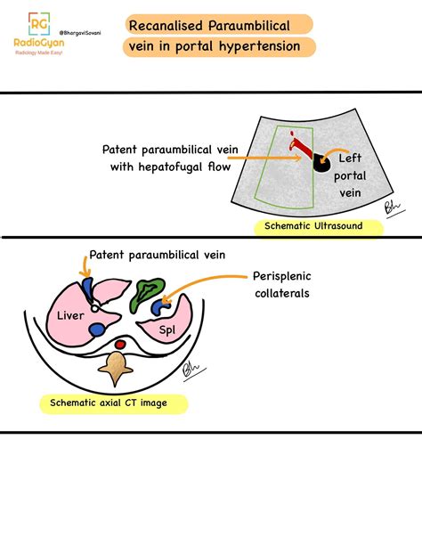 Paraumbilical Vein Ultrasound