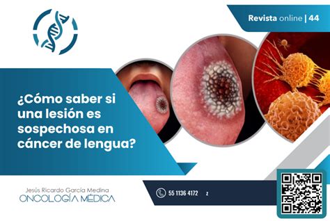 ¿cómo Saber Si Una Lesión Es Sospechosa En Cáncer De Lengua Dr Jesús Ricardo García Medina