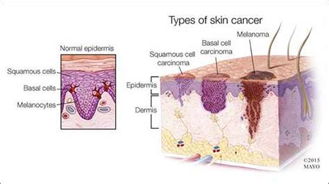 Living With Cancer Squamous Cell Carcinoma Of The Skin Mayo Clinic News Network