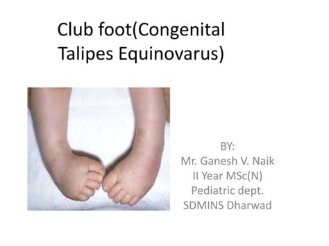 Club Foot Ppt