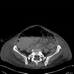 Tomodensitom Trie Abdominale Montrant Une Distension Franche Du Colon