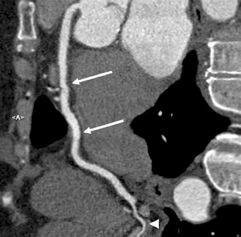 A Curved Multiplanar Reformatted Image Demonstrates The Entire Course Download Scientific