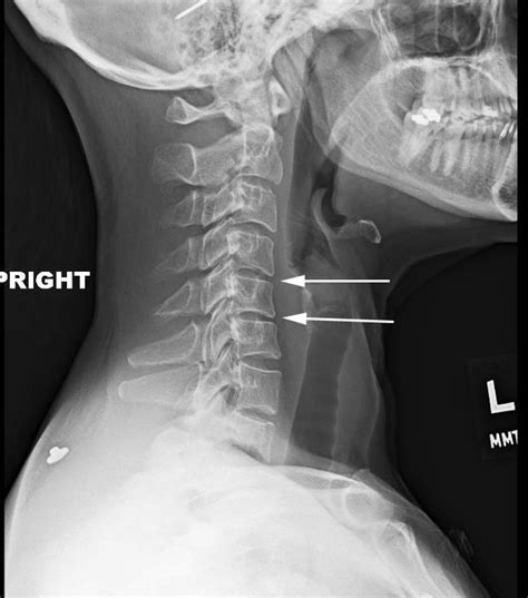 Cervical Degeneratinve Kyphosis Cervical Spine Denver Area