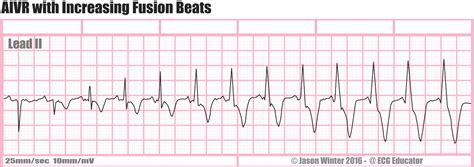 ECG Educator Blog : Accelerated Idioventricular Rhythm (AIVR)