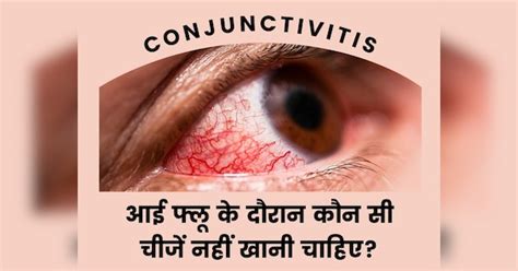 Conjunctivitis 8 Foods To Avoid In Eye Flu Home Remedies For Eye Infection Precaution Tips