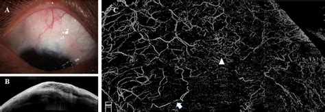 A Case With Failed Filtering Bleb By Iop Mm Hg A Slm Showing