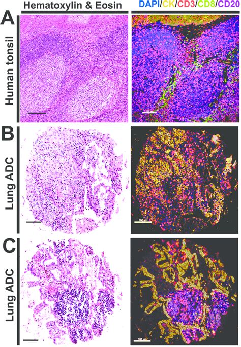 Characterization Of Tumor Infiltrating Lymphocyte TIL Subpopulations