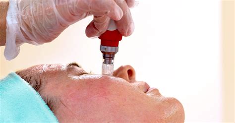 Microneedling Under The Eyes Procedure Cost And More