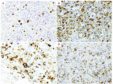 A In Situ Hybridization Of Epstein Barr Virus Encoded Rna Download Scientific Diagram