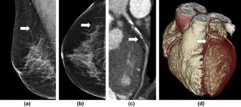 An Example Of A Patient With Severe Breast Arterial Calcification And