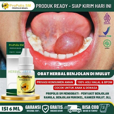 Jual Obat Herbal Benjolan Di Mulut Pada Anak And Dewasa Obat Benjolan Mukokel Obat Benjolan